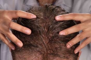 Integración de cabello sin cirugía