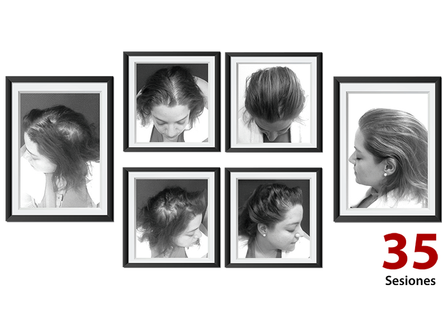 Detener caída cabello