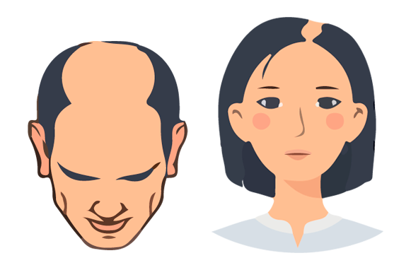Ilustración de hombre y mujer con integración de cabello sin cirugía - solución capilar no quirúrgica Svenson