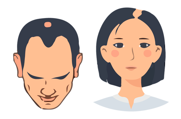 Ilustración de hombre y mujer con caída de cabello moderada - tratamiento capilar correctivo Svenson