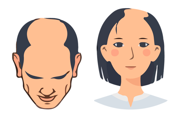 Ilustración de hombre y mujer con recuperación avanzada de cabello - tratamiento capilar de crecimiento Svenson