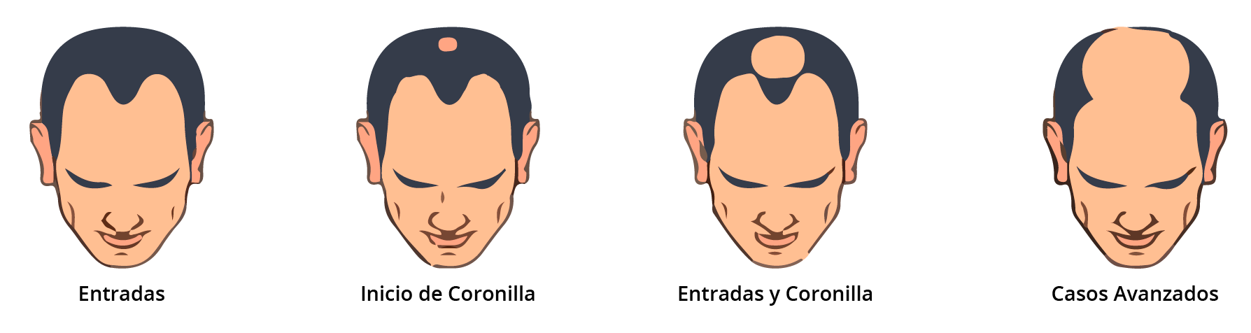 Escala de Hamilton-Norwood: grados de alopecia androgenética en hombres - clasificación de pérdida de cabello