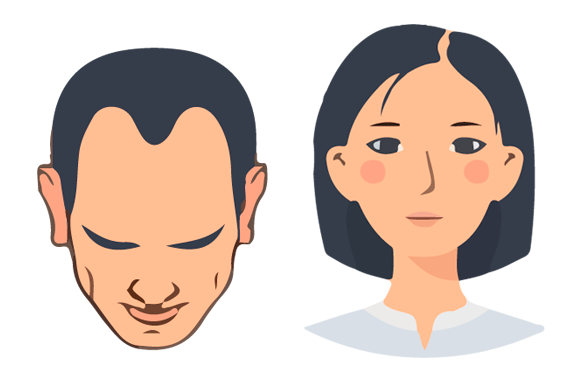 Ilustración de hombre y mujer con caída de cabello inicial - tratamiento capilar preventivo Svenson